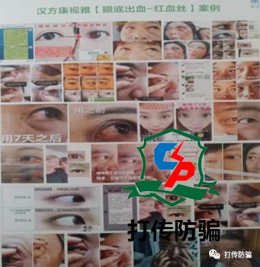 消费者使用“汉方康视雅”后失明住院：百万财富背后暗藏传销骗局消费者使用“汉方康视雅”后失明住院：百万财富背后暗藏传销骗局